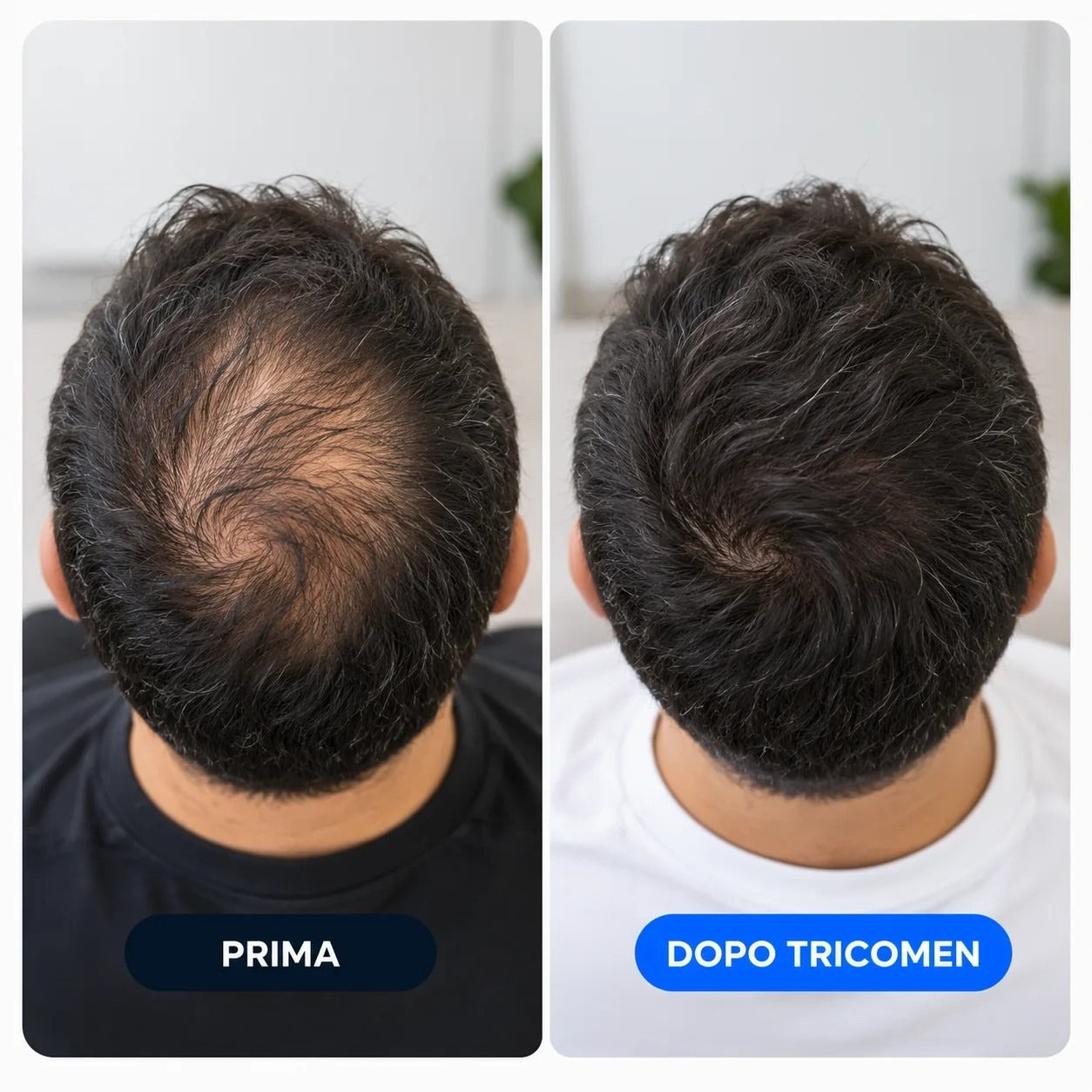 Risultato paziente prima e dopo TRICOMEN